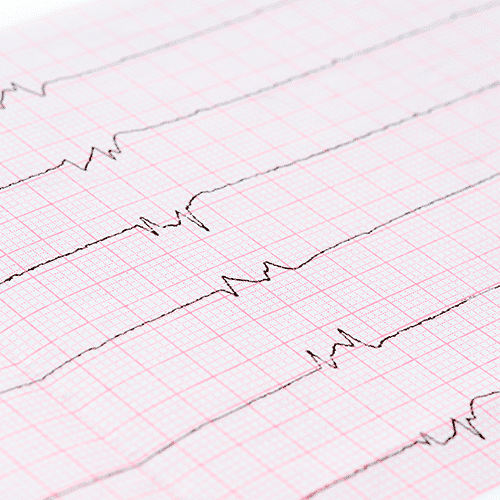 Illustration explaining what atrial fibrillation is