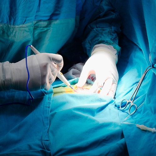 Catheter ablation and pulmonary vein isolation for atrial fibrillation