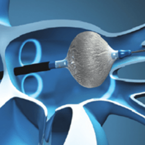 Cryoballoon ablation procedure for atrial fibrillation