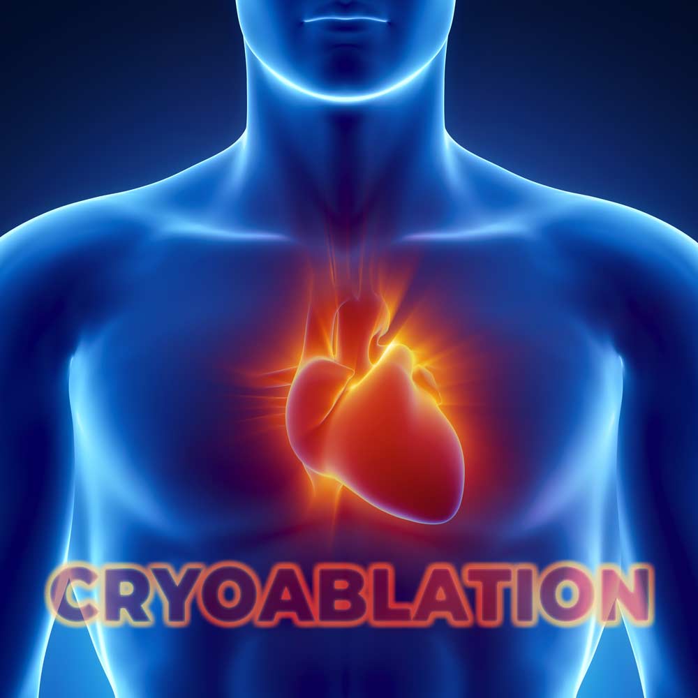 Cryoablation procedure for atrial fibrillation