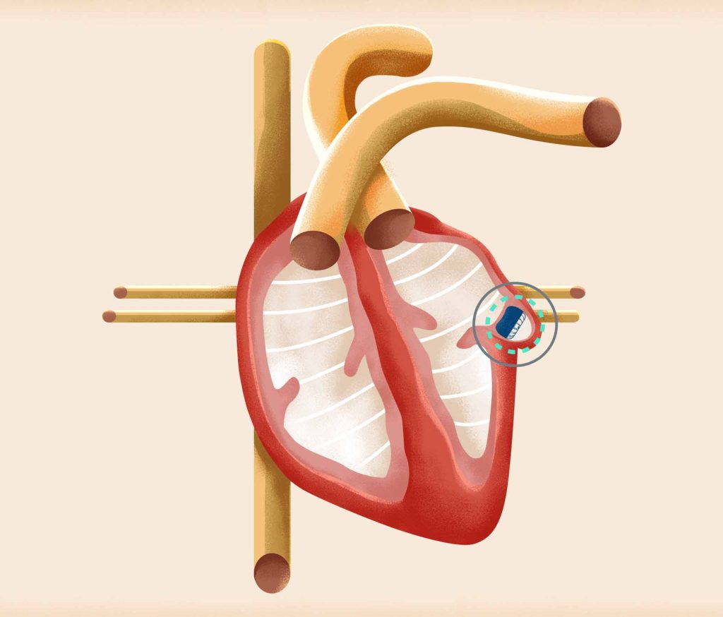 WATCHMAN procedure for atrial fibrillation stroke prevention