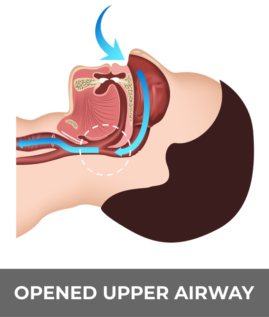 Sleep apnea diagram A related to atrial fibrillation