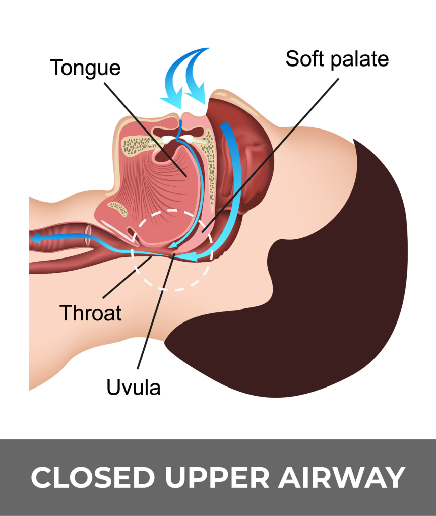 Sleep apnea diagram B related to atrial fibrillation